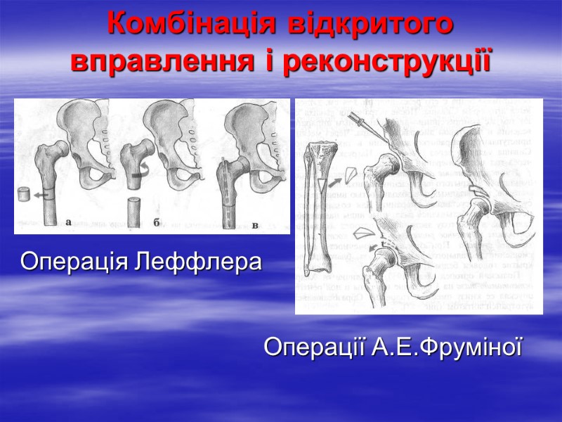 Комбінація відкритого вправлення і реконструкції Операція Леффлера Операції А.Е.Фруміної